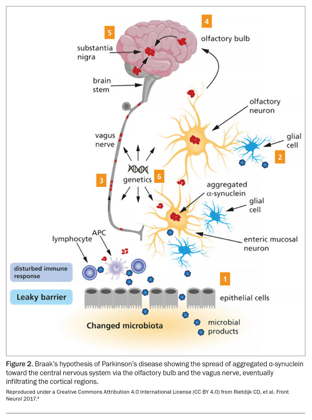 Advanced Parkinson’s Disease: A Clinical Challenge | Medicine Today